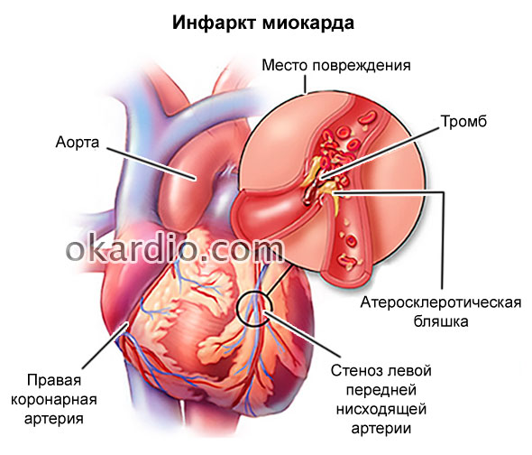 hiponenzijos gydymas moksonidinu)